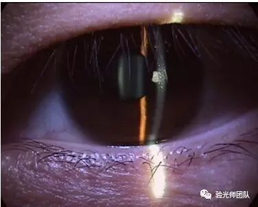 什么是裂隙灯验光检查裂隙灯检查什么？_https://www.jmylbn.com_新闻资讯_第6张