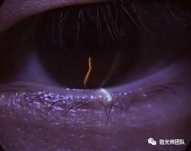 什么是裂隙灯验光检查裂隙灯检查什么？_https://www.jmylbn.com_新闻资讯_第7张