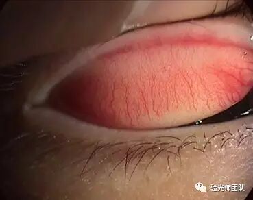 什么是裂隙灯验光检查裂隙灯检查什么？_https://www.jmylbn.com_新闻资讯_第5张