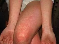 新加坡今年骨痛热病例比去年飙升300 3月内有3人死亡 新加坡眼 微信公众号文章阅读 Wemp