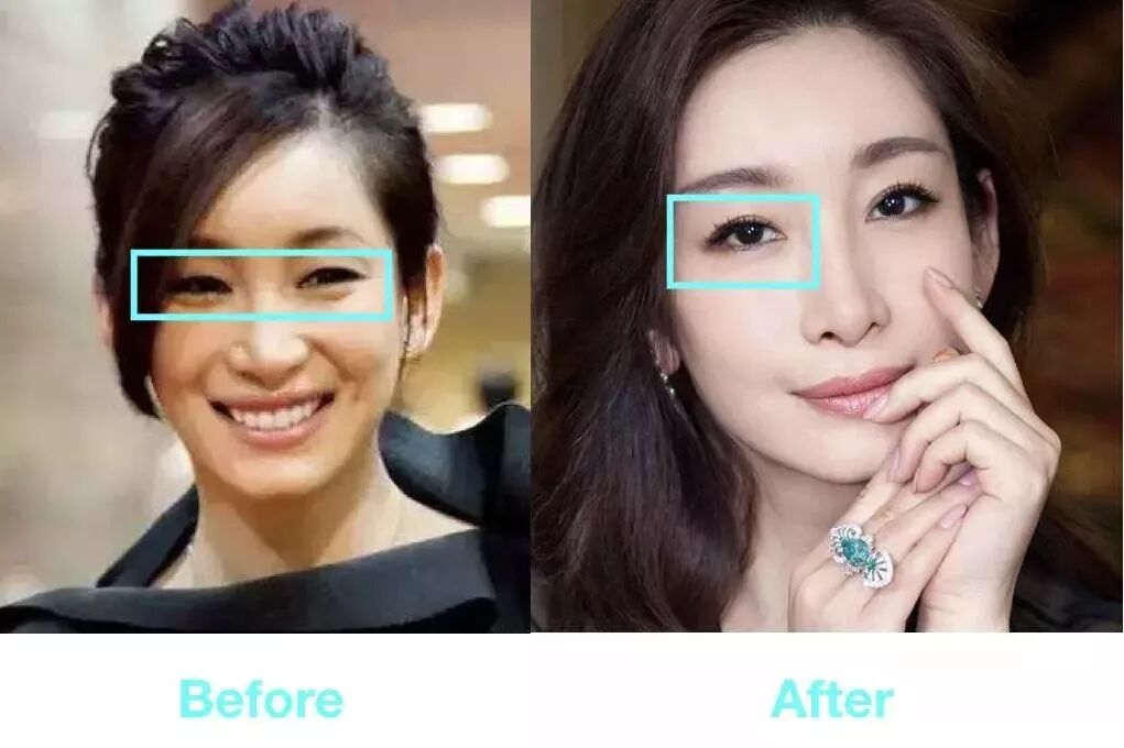 戚薇霸气公开割双眼皮,那些悄咪咪把眼睛变大的女明星有几个敢承认?