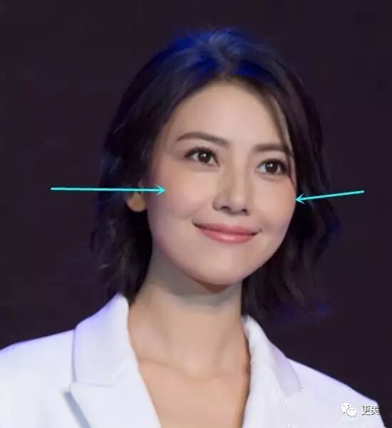 整好颧骨立体又耐老