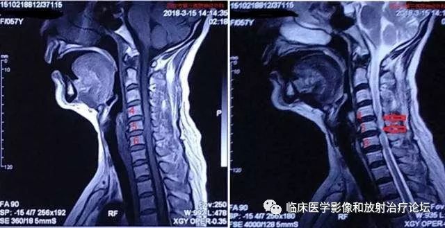 颈椎间盘突出会引起什么症状 如何治疗 液针刀骨伤医学研究院 微信公众号文章阅读 Wemp