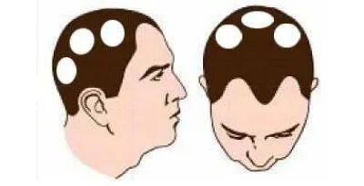 头发为什么要出现斑秃，应该怎样治疗？