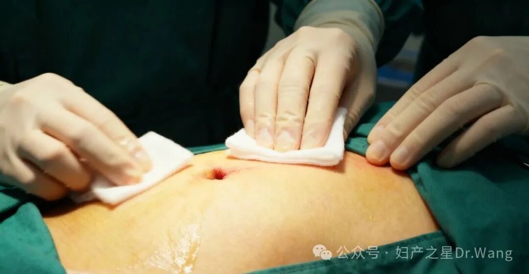 剖宫产手术拉勾怎么拉剖宫产手术【消毒范围、详细步骤、细节注意点】总结大全：建议小白反复观看_https://www.jmylbn.com_新闻资讯_第3张