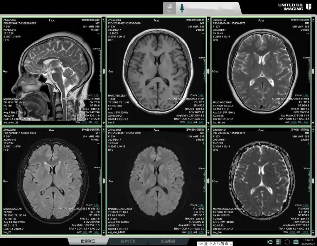 头颅mr77dwi高清dti三维重建mrcp成像磁共振关节软骨定量成像脊柱