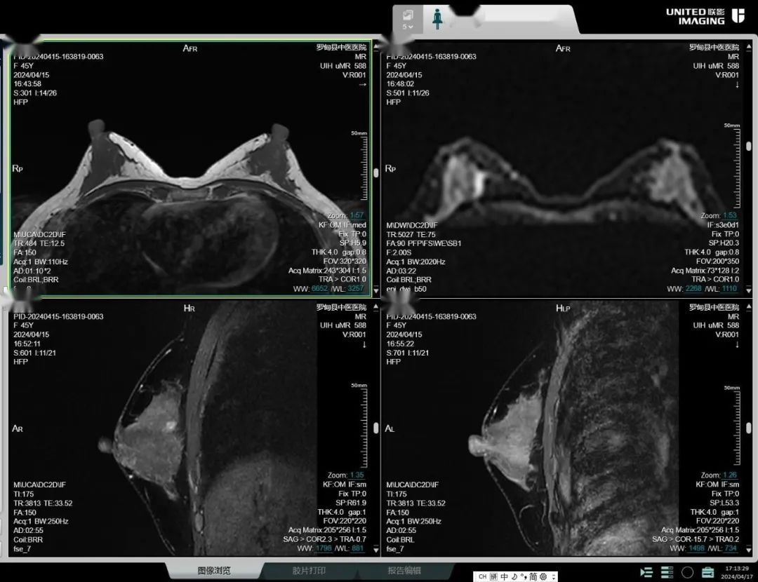 乳腺癌磁共振图片图片