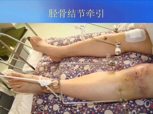 早读| 骨科牵引术的常用方式及要点