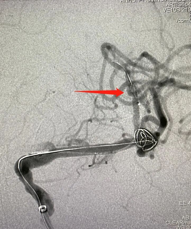 什么达医畅疗·第一期 ｜ 畅医达（Choydar）17小系统血流导向装置治疗大脑中动脉动脉瘤两例_https://www.jmylbn.com_新闻资讯_第14张