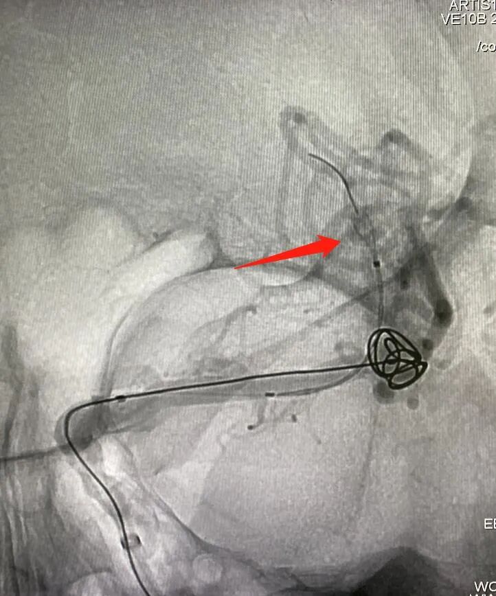 什么达医畅疗·第一期 ｜ 畅医达（Choydar）17小系统血流导向装置治疗大脑中动脉动脉瘤两例_https://www.jmylbn.com_新闻资讯_第15张