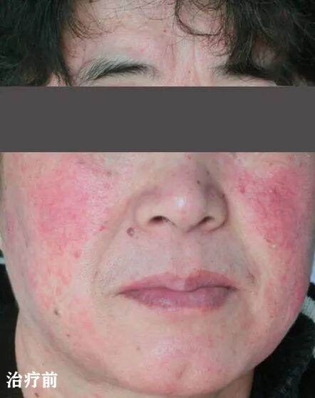 红蓝光治疗仪怎么使用皮肤科神器，痘痘杀手，神奇的“红蓝光”治疗仪_https://www.jmylbn.com_新闻资讯_第5张