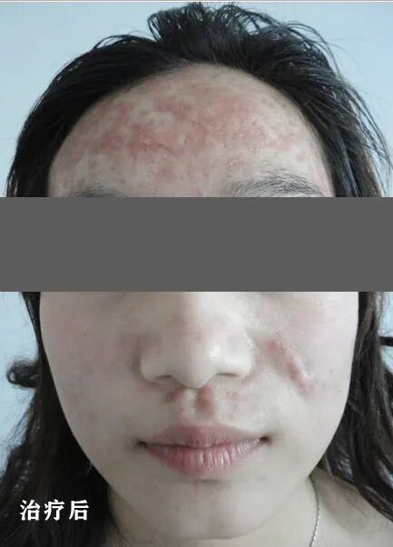 红蓝光治疗仪怎么使用皮肤科神器，痘痘杀手，神奇的“红蓝光”治疗仪_https://www.jmylbn.com_新闻资讯_第4张