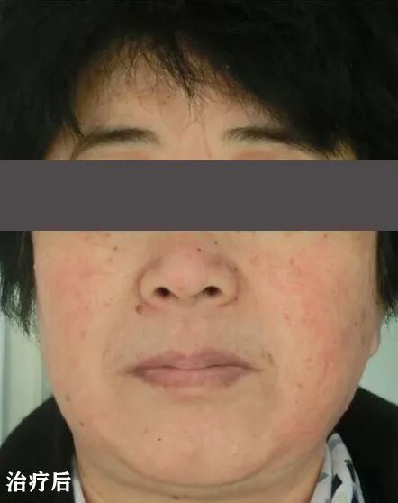 红蓝光治疗仪怎么使用皮肤科神器，痘痘杀手，神奇的“红蓝光”治疗仪_https://www.jmylbn.com_新闻资讯_第6张