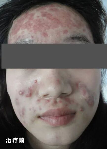 红蓝光治疗仪怎么使用皮肤科神器，痘痘杀手，神奇的“红蓝光”治疗仪_https://www.jmylbn.com_新闻资讯_第3张