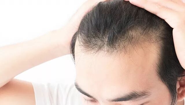 一个香港男人决定去科发源植发