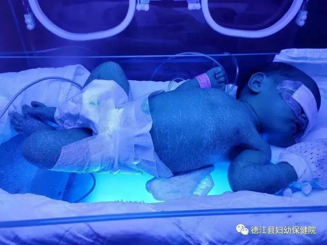 为什么要用光疗纸尿裤关于“蓝光”的点点滴滴_https://www.jmylbn.com_新闻资讯_第5张