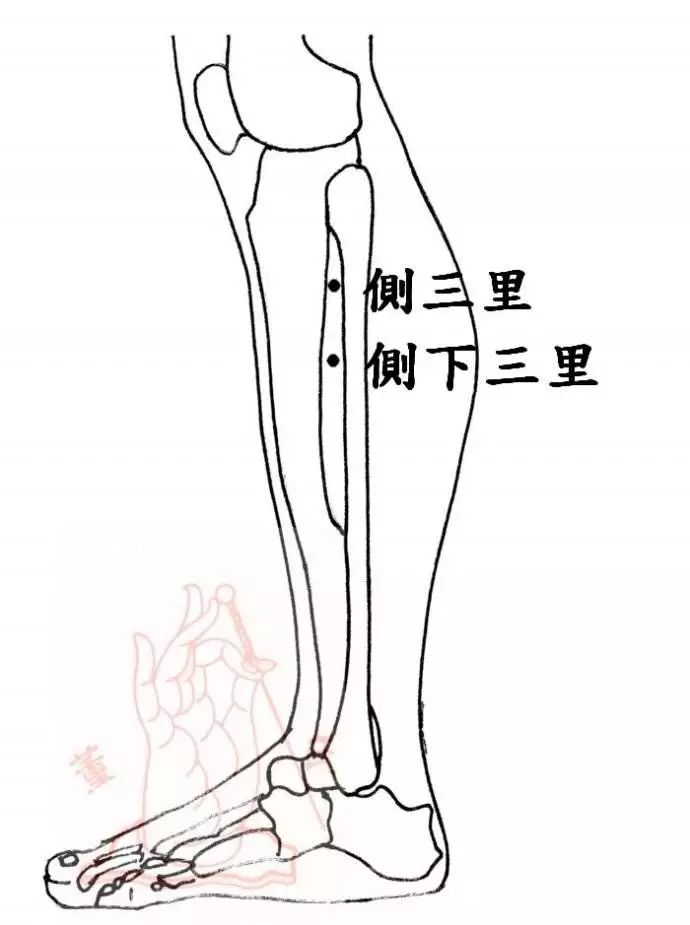 定位:侧三里穴位于四花上穴向外横开二寸五分,即十四经之足三里外一寸