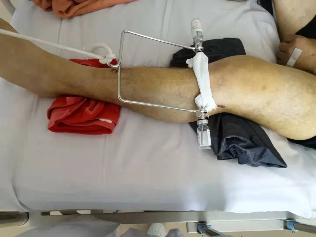 下肢牵引带怎么用带你认识骨科牵引术_https://www.jmylbn.com_新闻资讯_第6张
