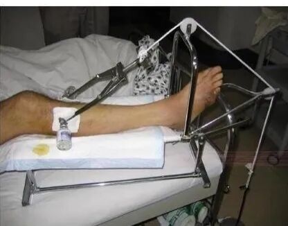 下肢牵引带怎么用带你认识骨科牵引术_https://www.jmylbn.com_新闻资讯_第4张