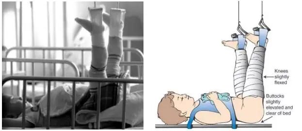 下肢牵引带怎么用带你认识骨科牵引术_https://www.jmylbn.com_新闻资讯_第5张