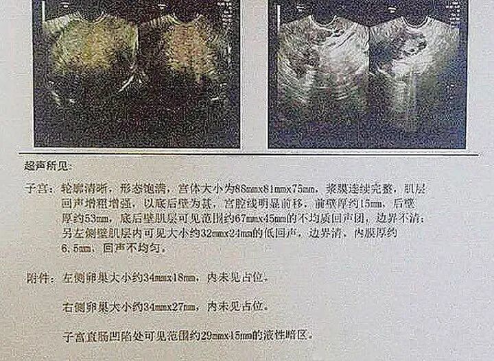 眼科ab超单怎么看看B超单怎么来确定是子宫腺肌症？王长杰医生来指导你正确认识它_https://www.jmylbn.com_新闻资讯_第1张