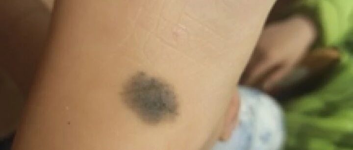 黑痣癌变，从发病到去世不到两个月！医生分析了100多颗黑痣，快来对照自查！