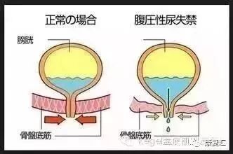 产后怎么康复治疗产后盆底肌肉的功能评估与康复治疗方案_https://www.jmylbn.com_新闻资讯_第2张