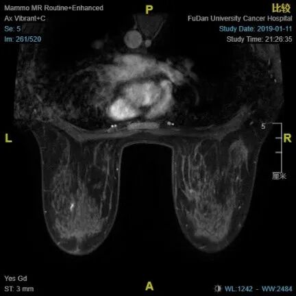 乳腺cr是什么【乳腺癌疑难病例＂艾月谈＂ 】艾赫新双靶新辅助治疗HER2阳性乳腺癌4周期获CR、tpCR，疗效安全皆可得_https://www.jmylbn.com_新闻资讯_第4张