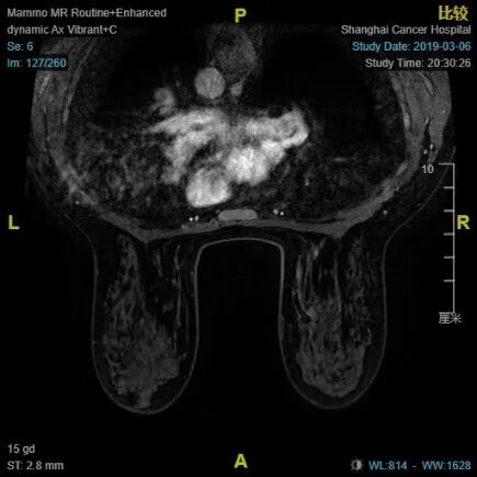 乳腺cr是什么【乳腺癌疑难病例＂艾月谈＂ 】艾赫新双靶新辅助治疗HER2阳性乳腺癌4周期获CR、tpCR，疗效安全皆可得_https://www.jmylbn.com_新闻资讯_第5张
