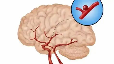 手术头皮夹怎么放【手术配合】颅内动脉瘤开颅手术步骤与配合_https://www.jmylbn.com_新闻资讯_第2张