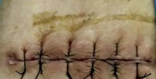 手术器具怎么消毒的18名剖宫产患者切口感染，这个科室的重要性不容忽视！_https://www.jmylbn.com_新闻资讯_第2张