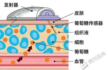 med笔怎么使用控血糖的 3 个新办法，有点好用_https://www.jmylbn.com_新闻资讯_第3张