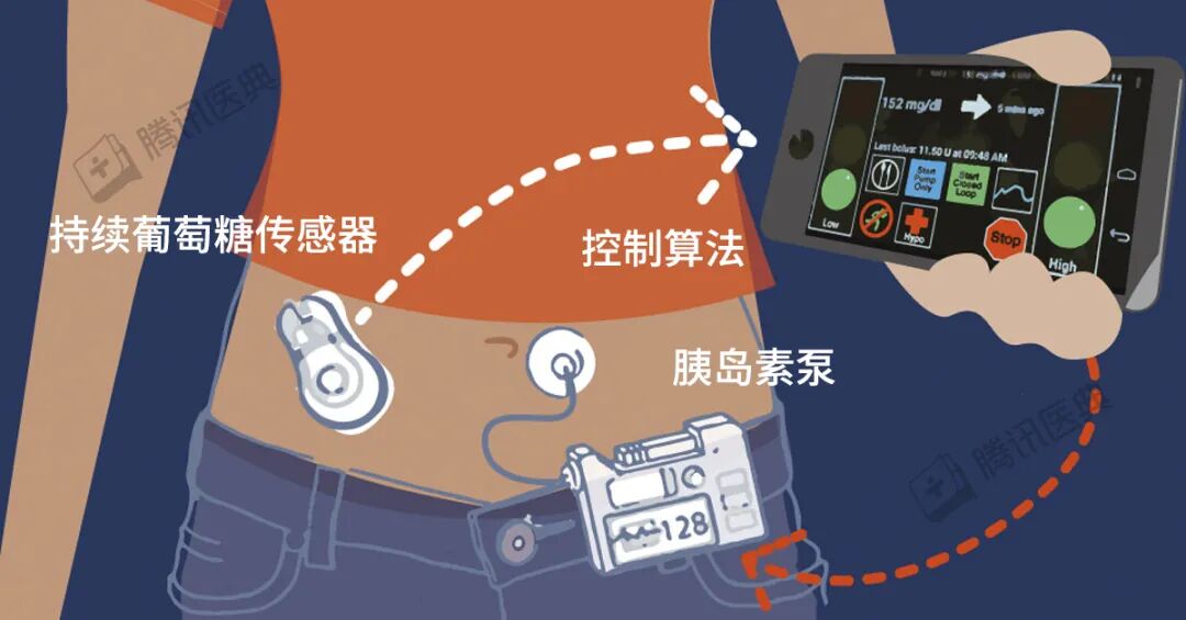 med笔怎么使用控血糖的 3 个新办法，有点好用_https://www.jmylbn.com_新闻资讯_第13张