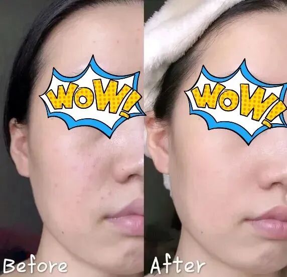 螨虫咬人后症状图片_怎么判断是螨虫咬的包_被子里的螨虫咬人吗