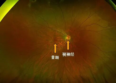 彩色眼底照相查什么一文读懂 ｜ “眼底照片”有何意义？哪些人需要做眼底检查？_https://www.jmylbn.com_新闻资讯_第3张