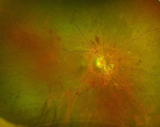 彩色眼底照相查什么一文读懂 ｜ “眼底照片”有何意义？哪些人需要做眼底检查？_https://www.jmylbn.com_新闻资讯_第5张