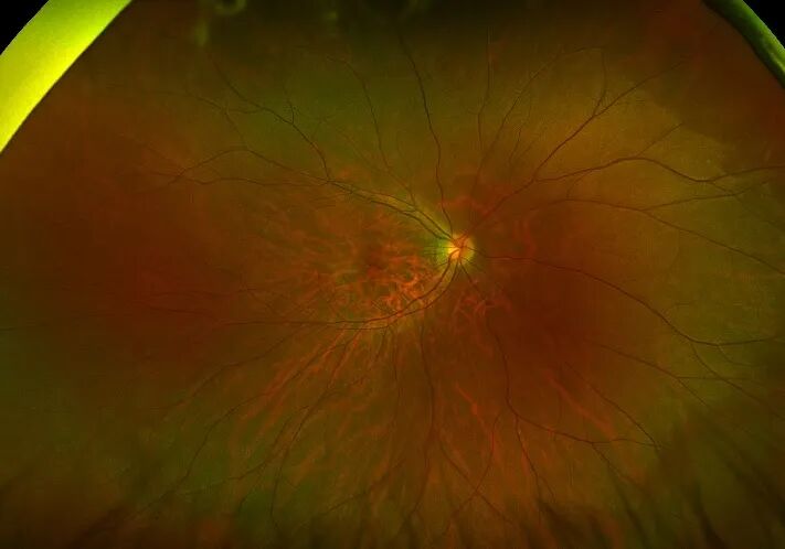 彩色眼底照相查什么一文读懂 ｜ “眼底照片”有何意义？哪些人需要做眼底检查？_https://www.jmylbn.com_新闻资讯_第2张