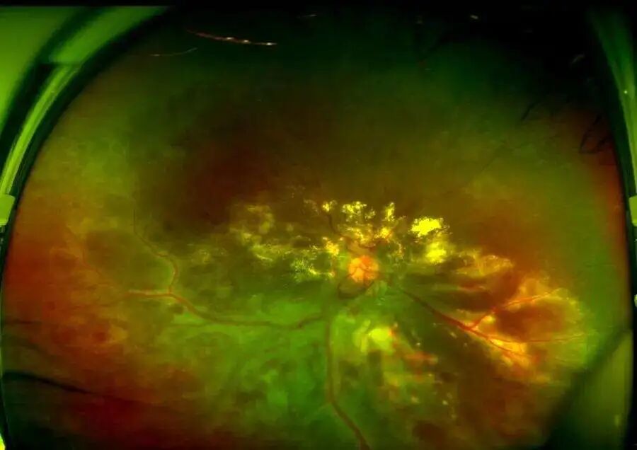 彩色眼底照相查什么一文读懂 ｜ “眼底照片”有何意义？哪些人需要做眼底检查？_https://www.jmylbn.com_新闻资讯_第6张