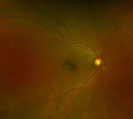 彩色眼底照相查什么一文读懂 ｜ “眼底照片”有何意义？哪些人需要做眼底检查？_https://www.jmylbn.com_新闻资讯_第8张