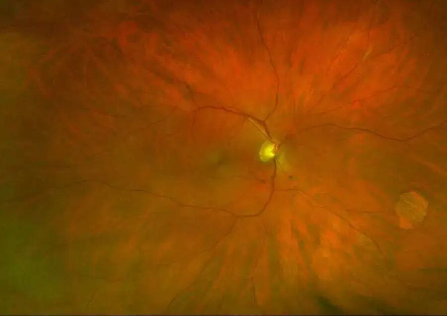 彩色眼底照相查什么一文读懂 ｜ “眼底照片”有何意义？哪些人需要做眼底检查？_https://www.jmylbn.com_新闻资讯_第7张