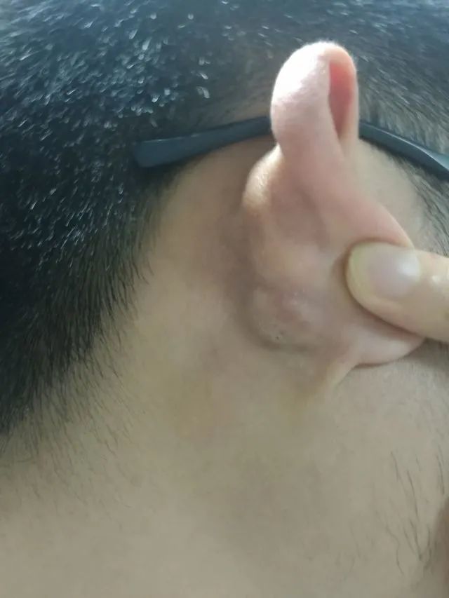 皮脂腺囊肿