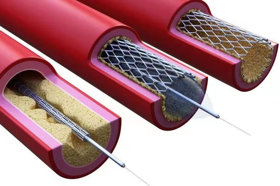 什么是外周支架【世界心脏日】心脏支架植入，八大“灵魂拷问”_https://www.jmylbn.com_新闻资讯_第8张