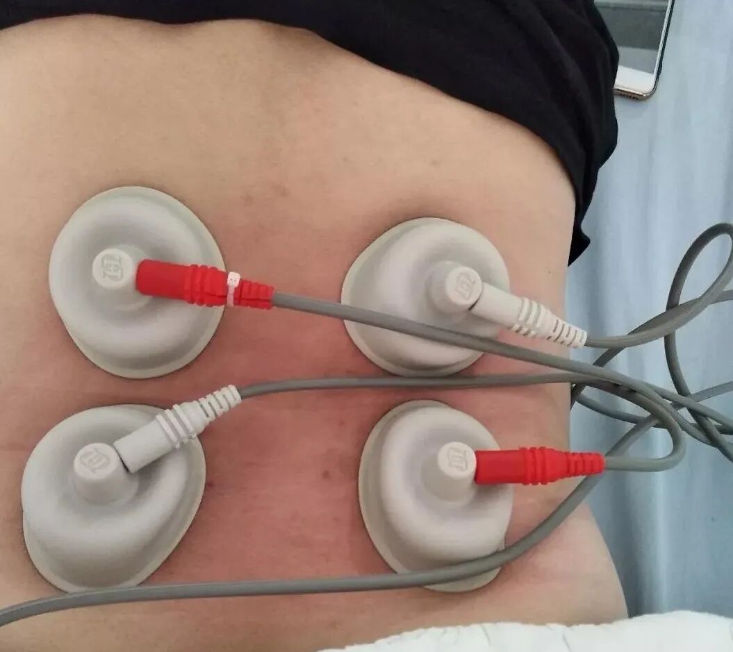 什么是中频干扰中频电疗神器——干扰电疗法_https://www.jmylbn.com_新闻资讯_第11张