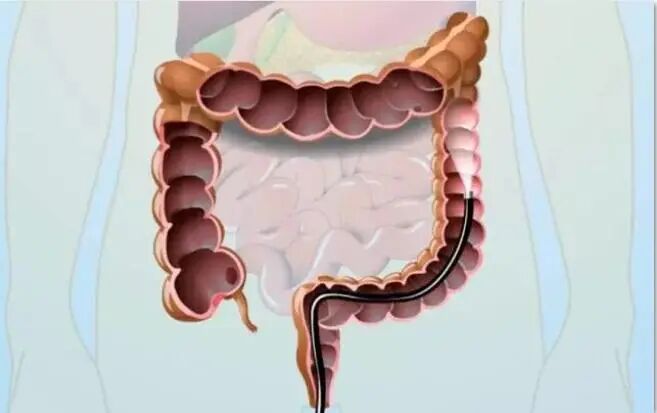 电子直肠镜怎么做做结直肠镜检查前，要做好哪些准备？_https://www.jmylbn.com_新闻资讯_第6张