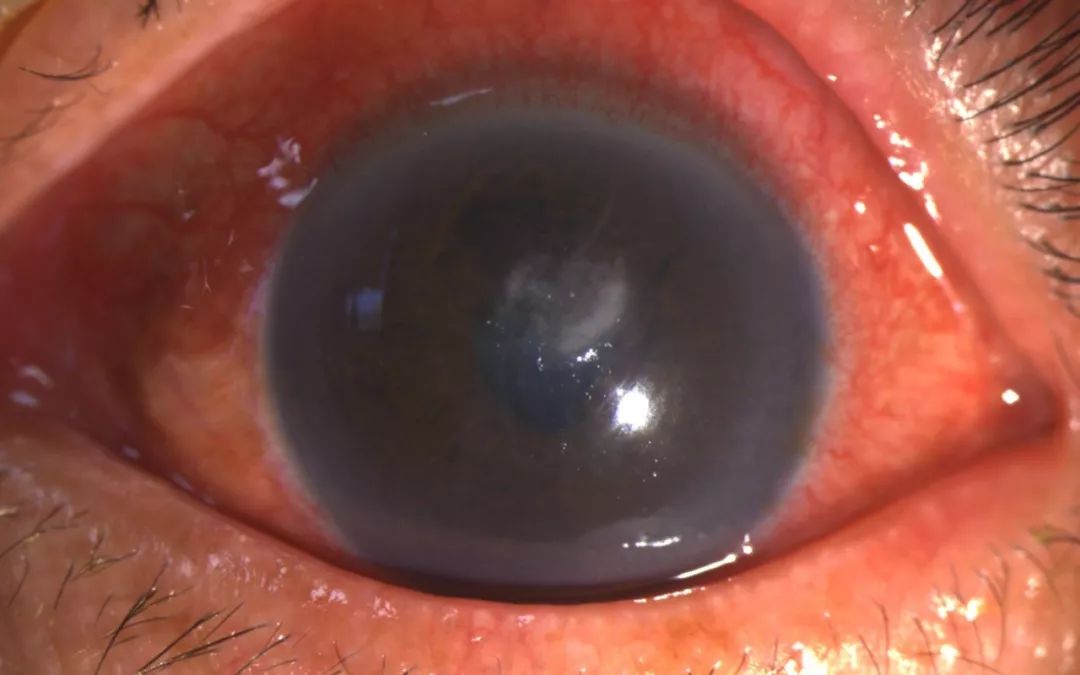 刘先生诊断为左眼细菌性角膜炎,左眼视力只剩0