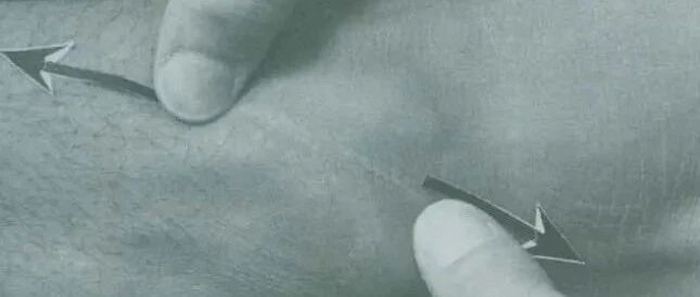 手把手教你瘢痕组织的三种松解技术