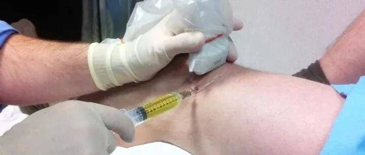 膝盖有积液？处理治疗一看就明白