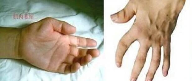 肩手综合征的康复治疗