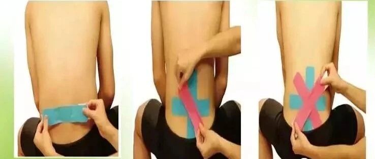 肌内效贴扎技术在康复中的应用（含具体治疗案例图解）