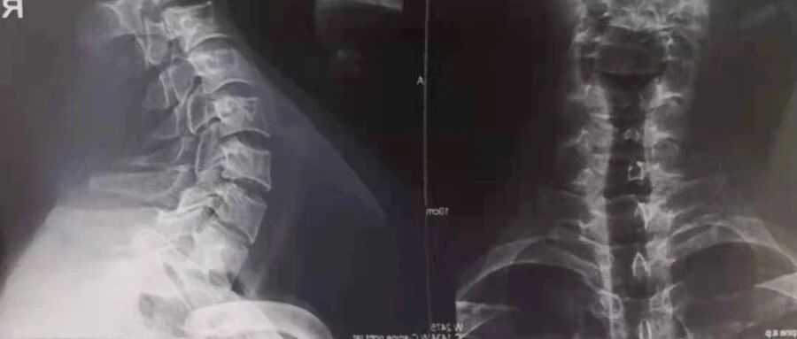 治疗师们请注意，这些禁忌症不能采用手法治疗，盲目上手可能导致瘫痪！